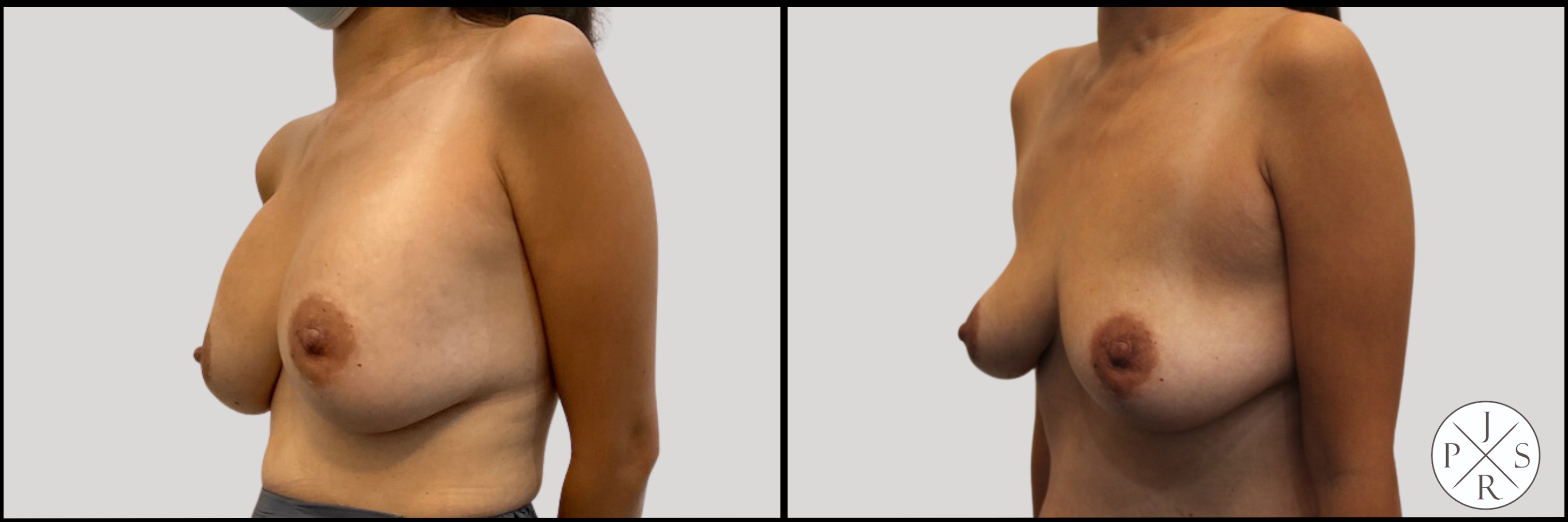 Breast Implant Removal Before & After Image